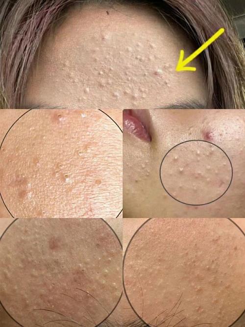 闭口粉刺长什么样