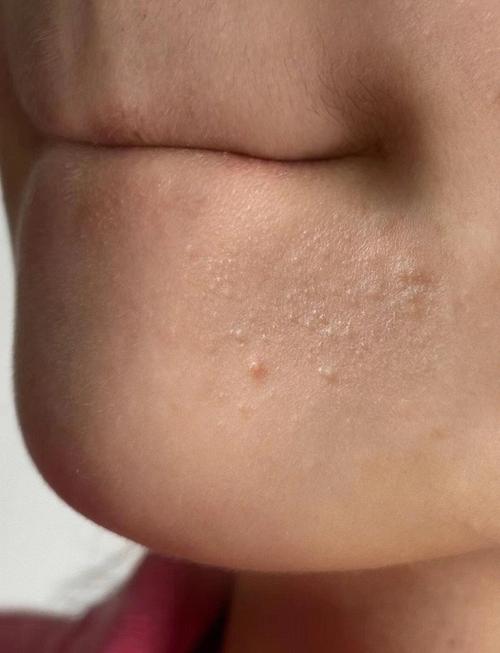 闭口粉刺长什么样