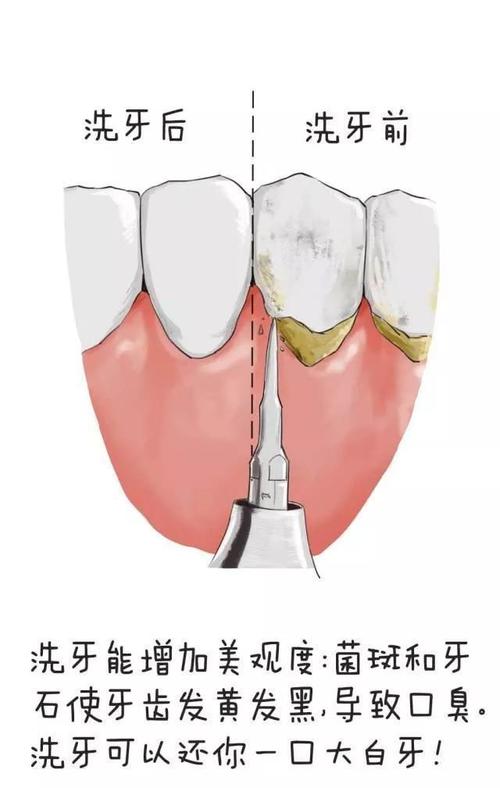 洗牙的原理是什么