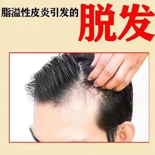 头发脱落吃什么药