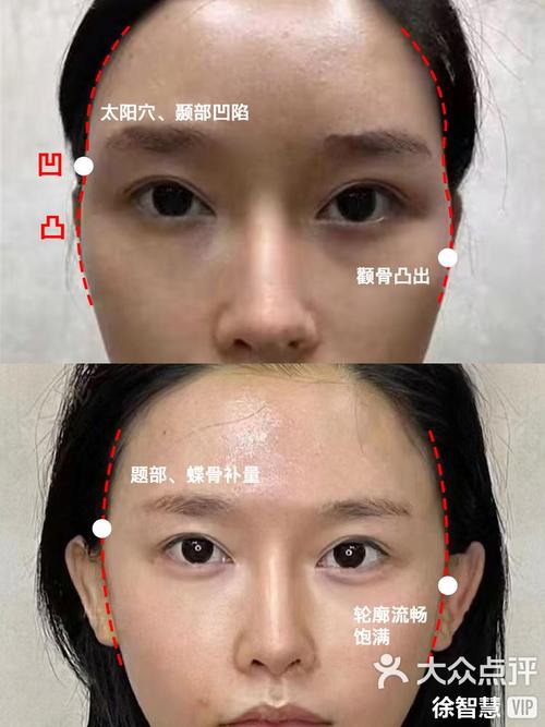 太阳凹陷什么原因