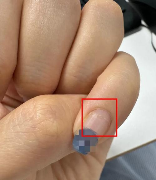 指甲分层是缺什么