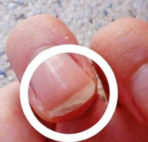 指甲分层是缺什么