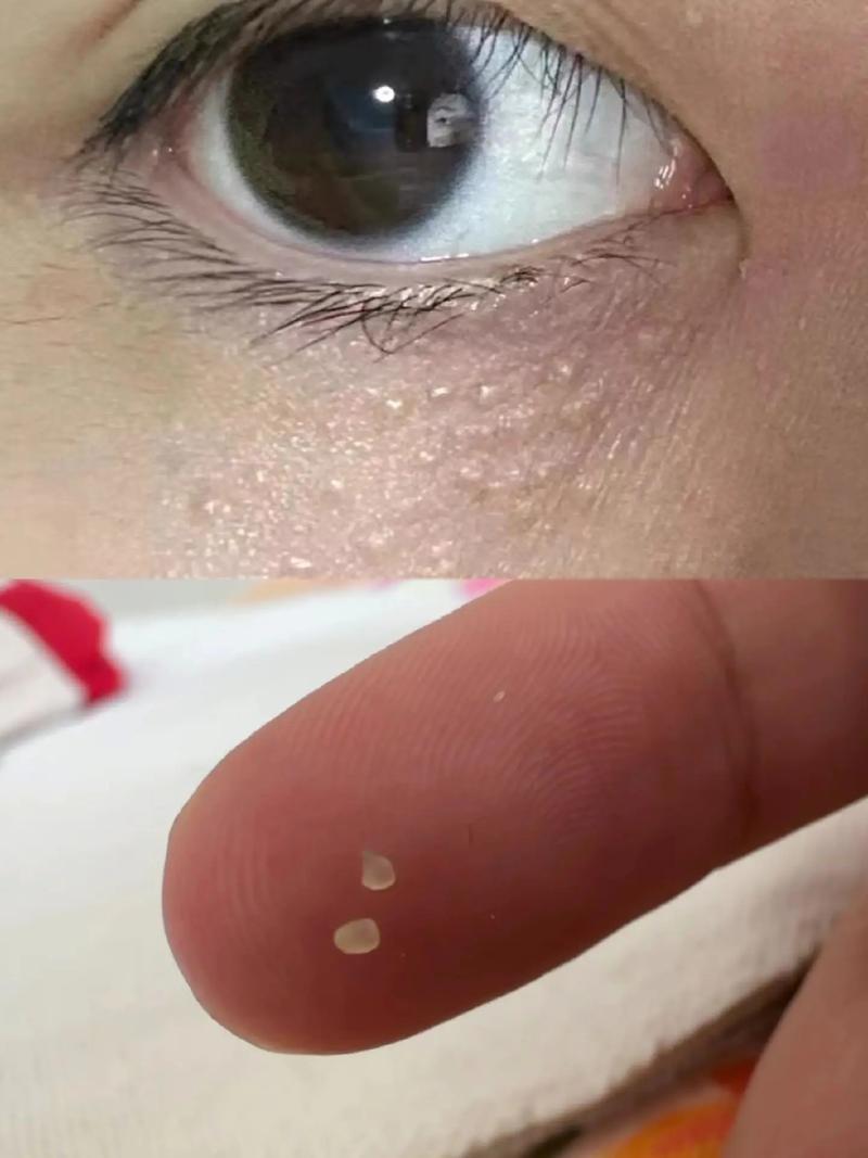 脂肪粒是什么东西