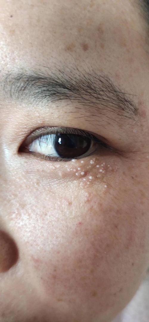 脂肪粒是什么东西