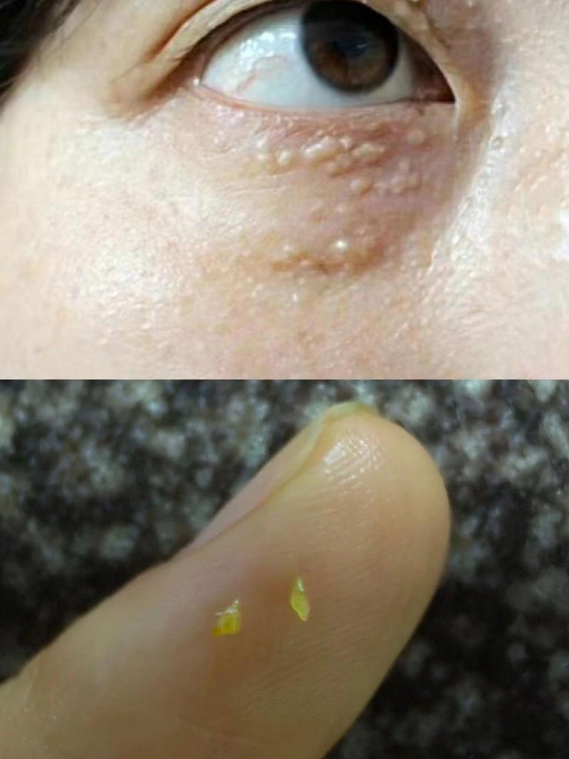 脂肪粒是什么东西