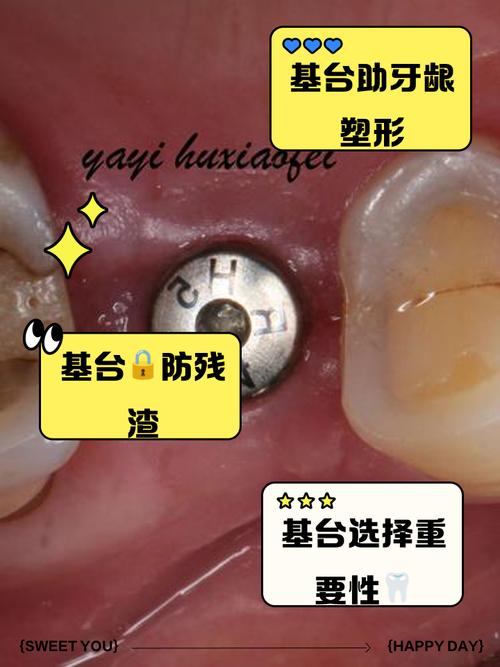 种植牙基台是什么