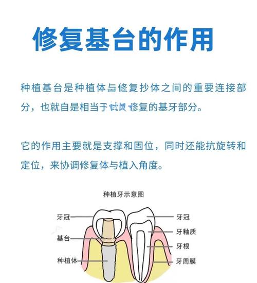 种植牙基台是什么