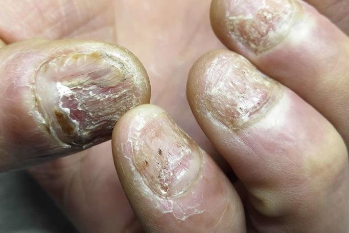 指甲会有什么病