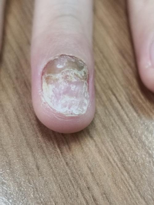 指甲会有什么病