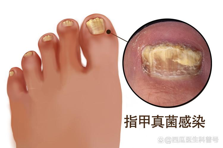 指甲会有什么病