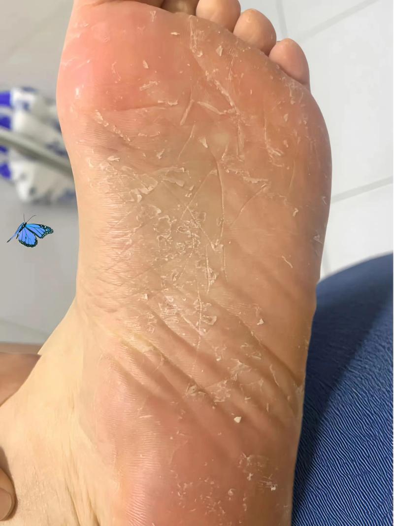 脚脱皮为什么