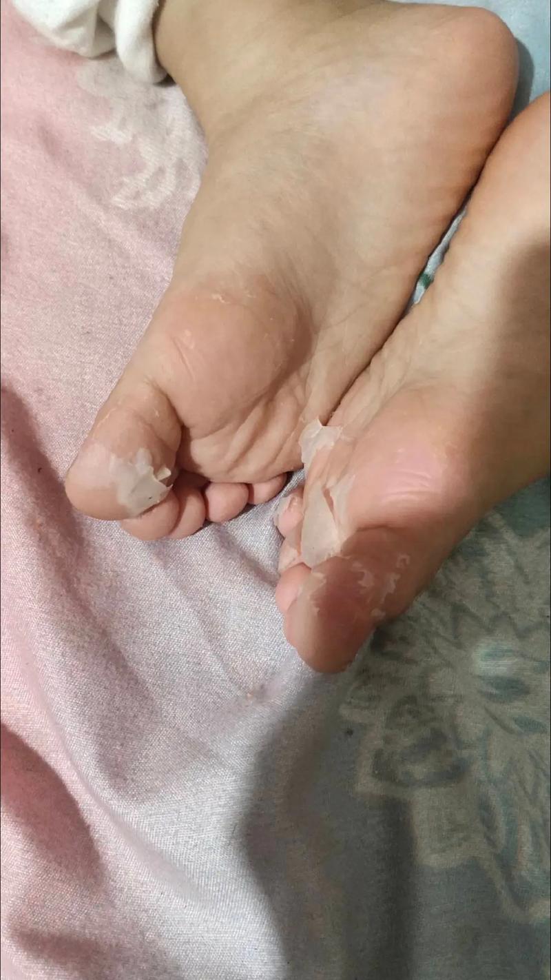 脚脱皮为什么