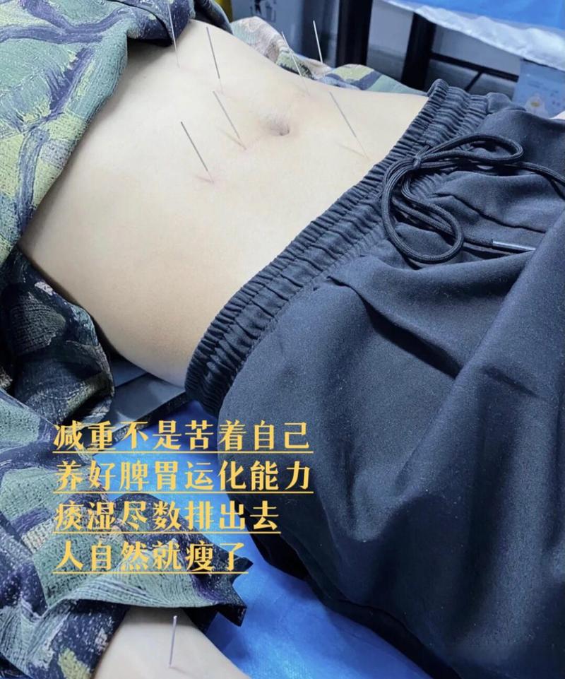 针灸减肥什么感觉