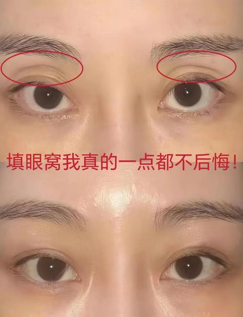 为什么眼窝会凹陷