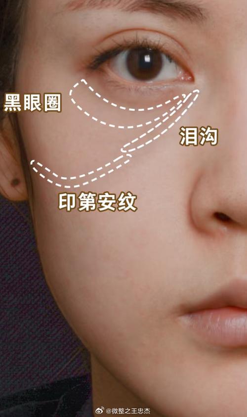 为什么眼窝会凹陷