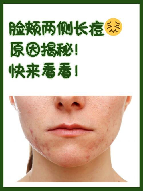 脸上为什么会长粉刺