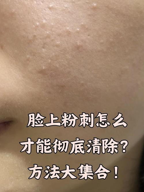 脸上为什么会长粉刺