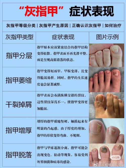 什么治疗灰指甲最好