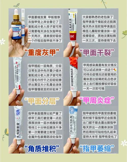 什么治疗灰指甲最好