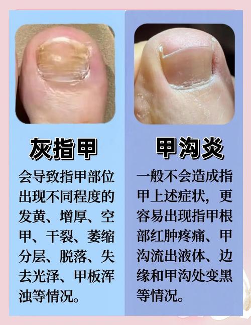 什么治疗灰指甲最好