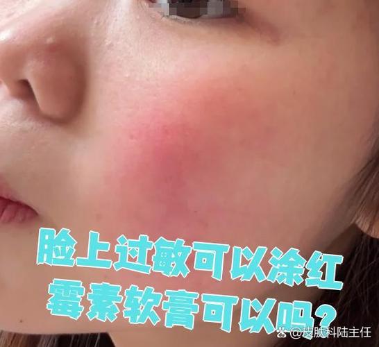 脸上过敏擦什么好