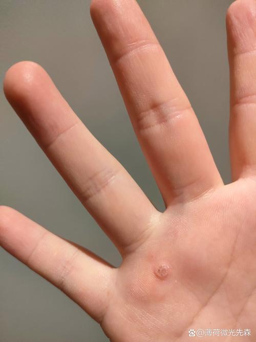 手上为什么长鸡眼
