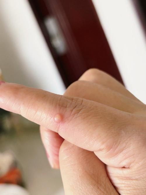 手上为什么长鸡眼