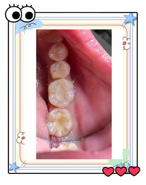 补牙有什么材质