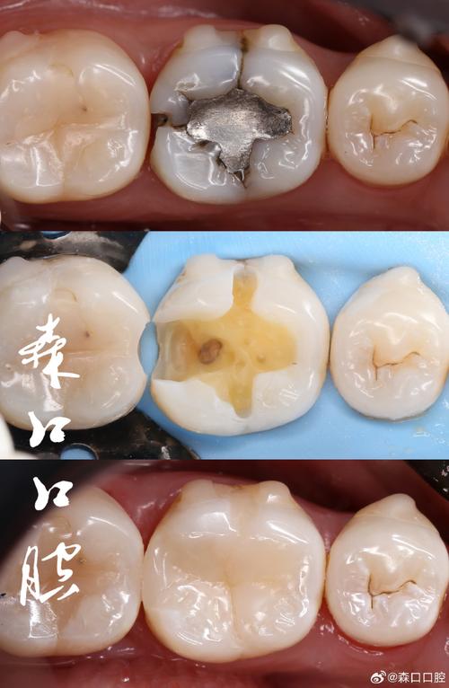 补牙有什么材质