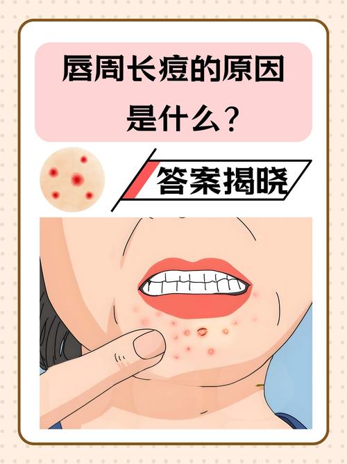 嘴巴长痘痘是什么原因