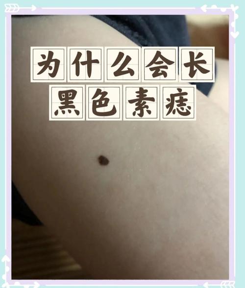 色素痣是什么样的