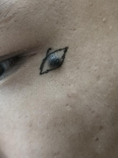 色素痣是什么样的