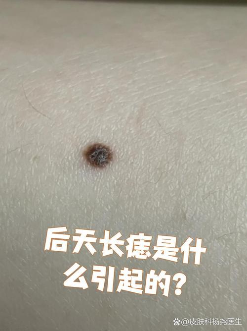 色素痣是什么样的