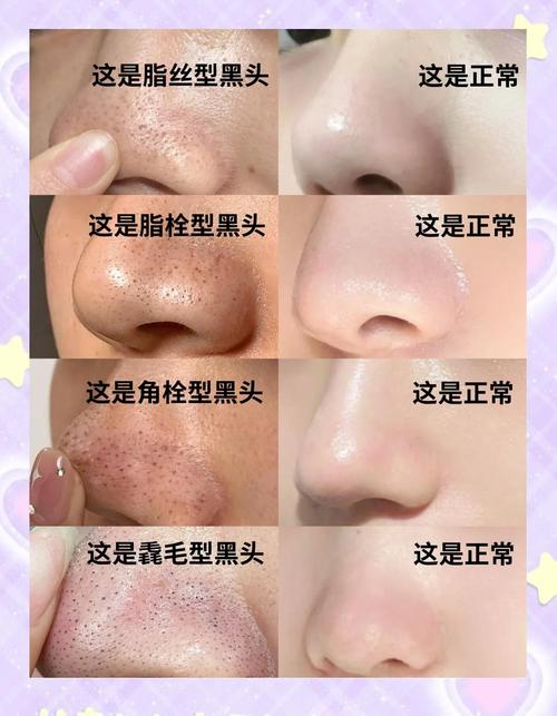 去黑头是什么意思