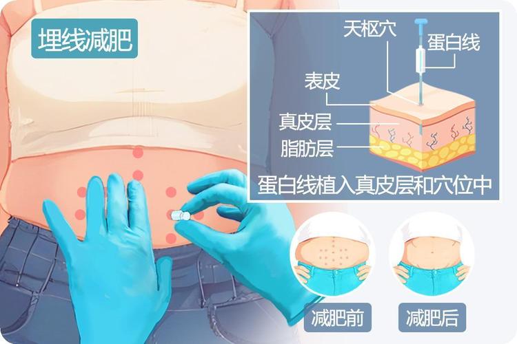 埋蛋白线减肥有什么副作用