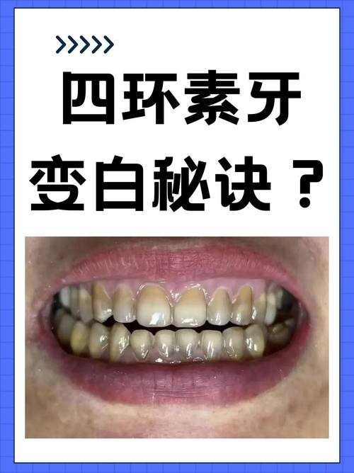 四环素牙是什么