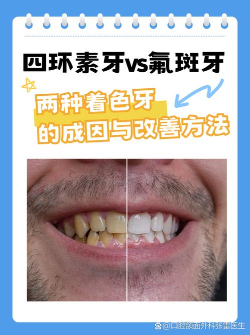 四环素牙是什么