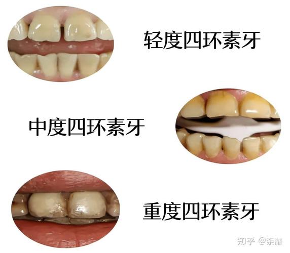 四环素牙是什么