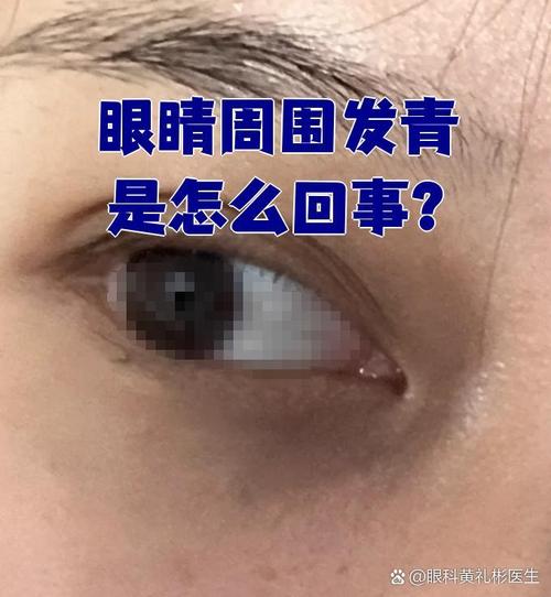 眼睛发青是什么原因