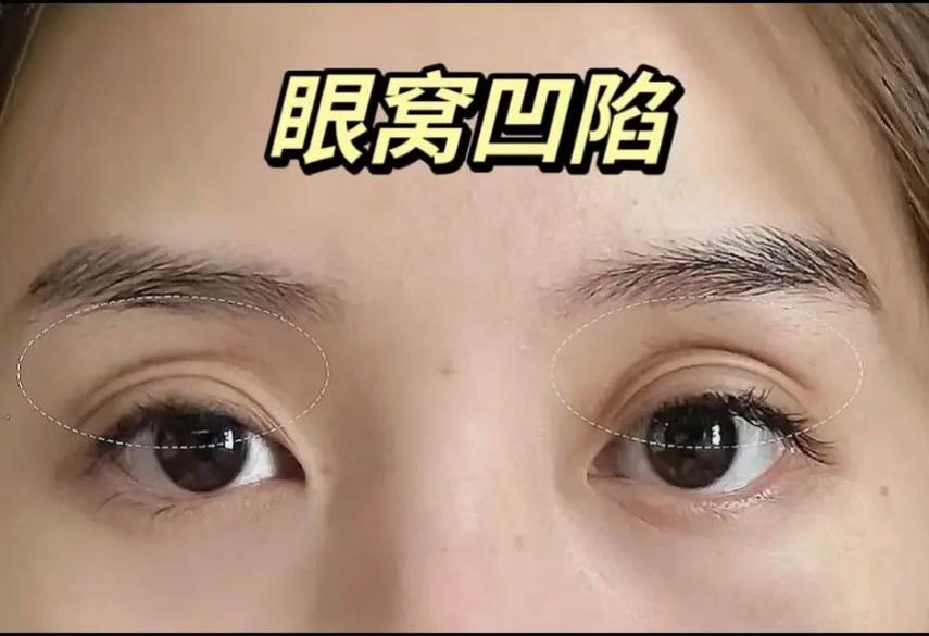 为什么会眼窝凹陷