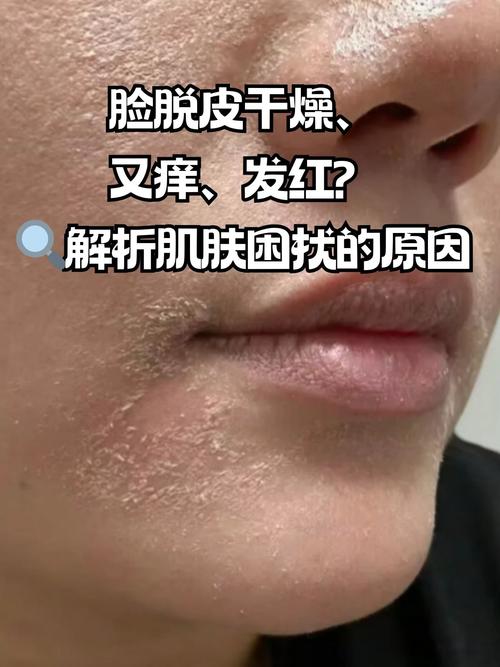 为什么脸总是过敏