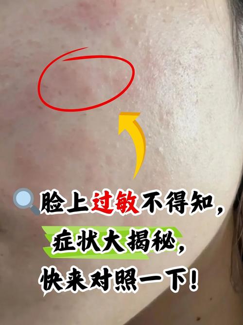 为什么脸总是过敏