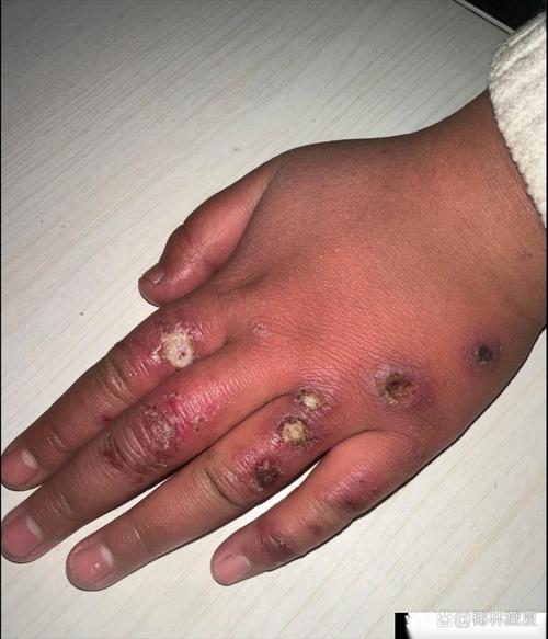 冻疮有什么症状