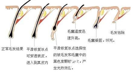 激光脱毛什么原理