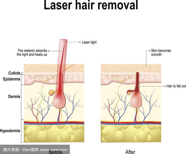 激光脱毛什么原理