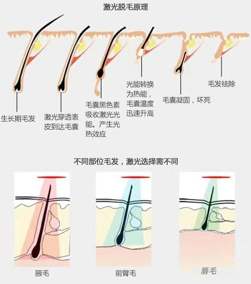 激光脱毛什么原理