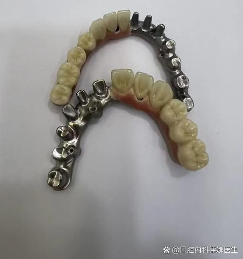 镶什么样的牙好