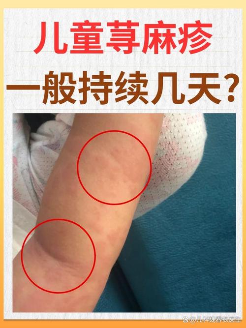 荨麻疹什么时候好