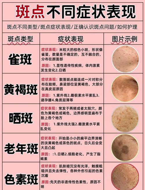 为什么会有黄褐斑